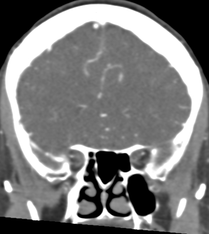Basilar tip aneurysm with coiling (Radiopaedia 53912-60086 B 43).jpg
