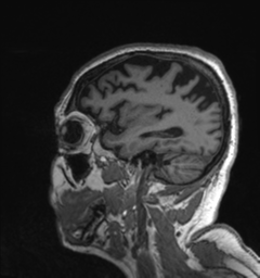 Behavioral variant frontotemporal dementia and late onset schizophrenia (Radiopaedia 52197-58083 Sagittal T1 16).png