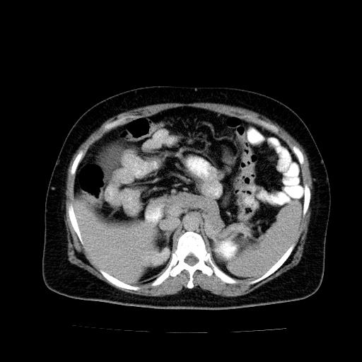 File:Benign spindle cell tumor - abdominopelvic (Radiopaedia 61300-69212 Axial C+ delayed 17).jpg