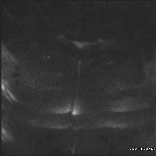 File:Bicornuate uterus (MRI) (Radiopaedia 49206-54297 Axial 119).jpg