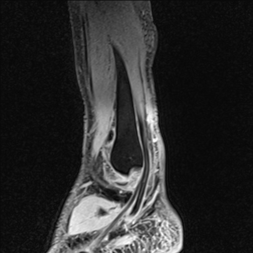 Bilateral Achilles tendon complete tear (Radiopaedia 81344-95051 Sagittal WE - Left 93).jpg