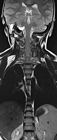 File:Bilateral Sprengel deformity with Klippel-Feil syndrome (Radiopaedia 66395-75650 F 5).jpg