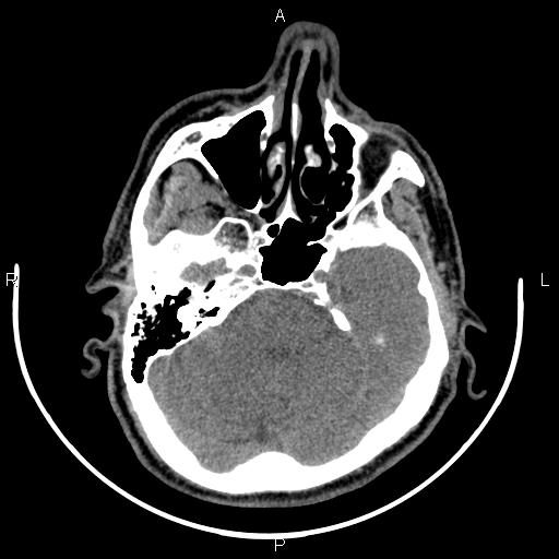 Bilateral Warthin tumors (Radiopaedia 84034-99263 Axial non-contrast 2).jpg