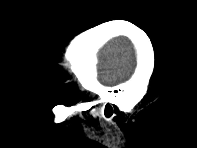 Bilateral acute on chronic subdural hematomas (Radiopaedia 78466-91146 C 10).jpg