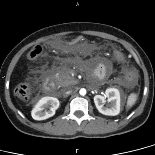 Bilateral adrenal gland hyperenhancement in pancreatitis (Radiopaedia 86642-102753 B 59).jpg