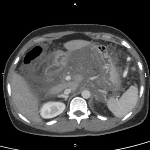 File:Bilateral adrenal gland hyperenhancement in pancreatitis (Radiopaedia 86642-102753 E 27).jpg