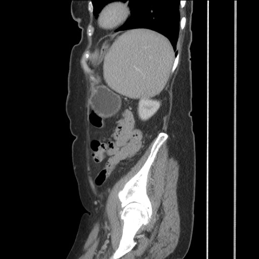 Bilateral adrenal granulocytic sarcomas (chloromas) (Radiopaedia 78375-91007 C 108).jpg