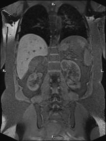 File:Bilateral adrenal myelolipoma (Radiopaedia 63058-71537 Coronal T1 fat sat 38).jpg