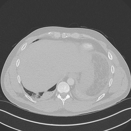 File:Bilateral atelectasis (Radiopaedia 48666-53675 Axial lung window 96).jpg