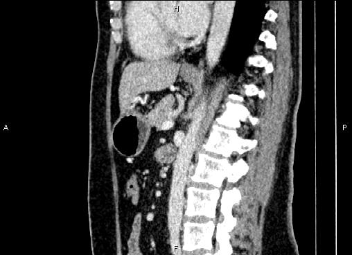 Bilateral benign adrenal adenomas (Radiopaedia 86912-103124 E 56).jpg