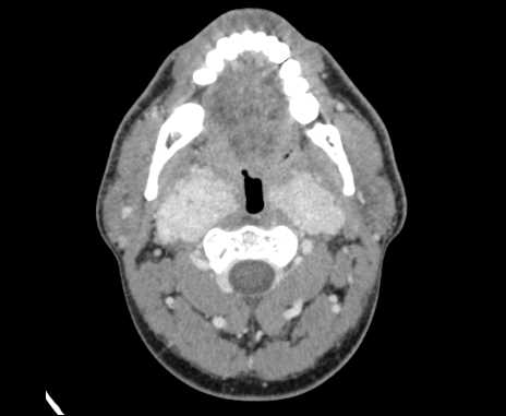 Bilateral carotid body tumors (Radiopaedia 61841-69870 Axial Post contrast 31).jpg