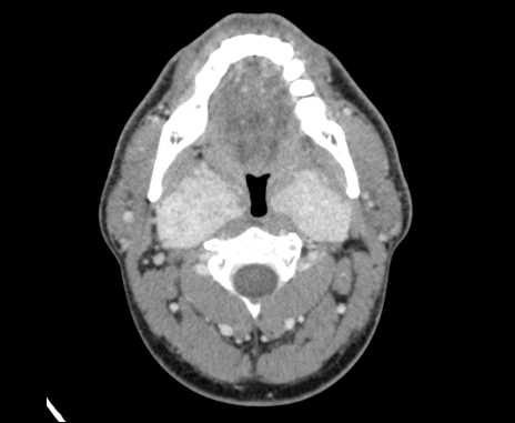 Bilateral carotid body tumors (Radiopaedia 61841-69870 Axial Post contrast 33).jpg