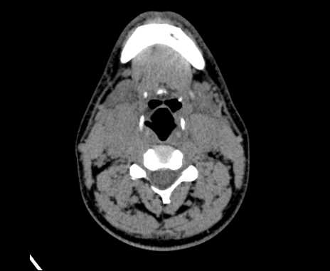 Bilateral carotid body tumors (Radiopaedia 61841-69870 Axial non-contrast 52).jpg
