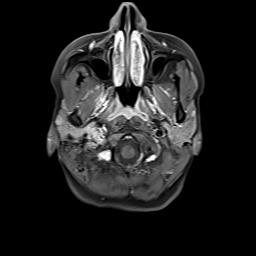 File:Bilateral carotid body tumors and right jugular paraganglioma (Radiopaedia 20024-20060 Axial 107).jpg
