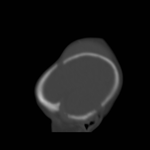File:Bilateral cephalohematomas and subdural hematomas (Radiopaedia 26778-26929 Sagittal bone window 5).jpg
