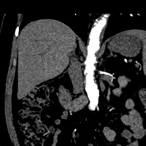 File:Bilateral delayed nephrogram from renal artery stenosis (Radiopaedia 47681-52362 C 4).png