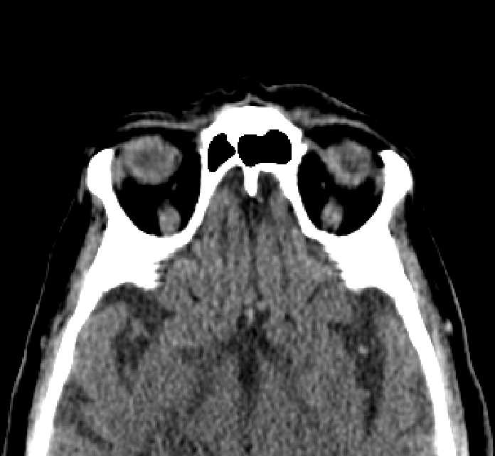 Bilateral ectopia lentis (Radiopaedia 89889-107013 Axial non-contrast 18).jpg