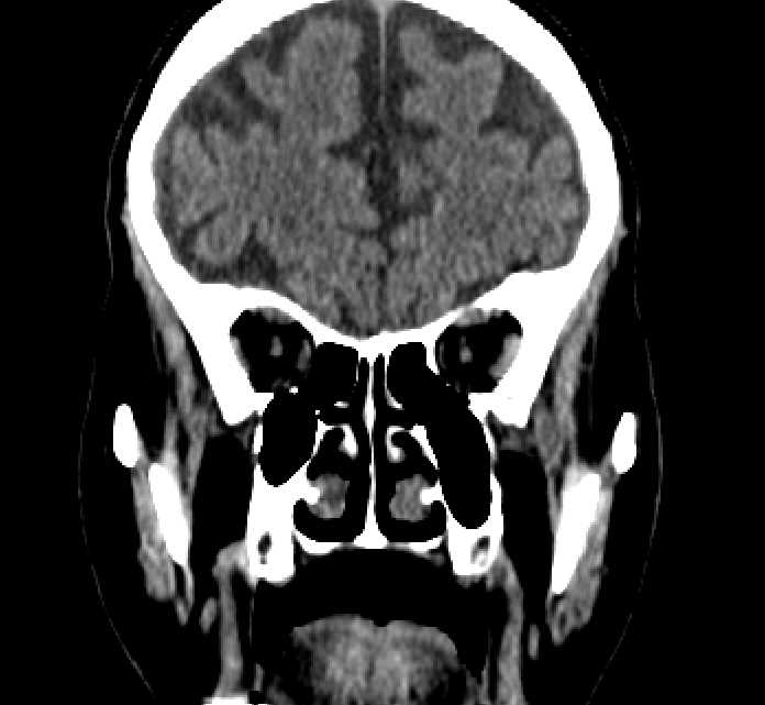 Bilateral ectopia lentis (Radiopaedia 89889-107013 Coronal non-contrast 81).jpg