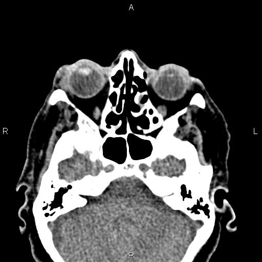 Bilateral enlargement of lacrimal glands - sarcoidosis (Radiopaedia 62627-70921 Axial non-contrast 35).jpg