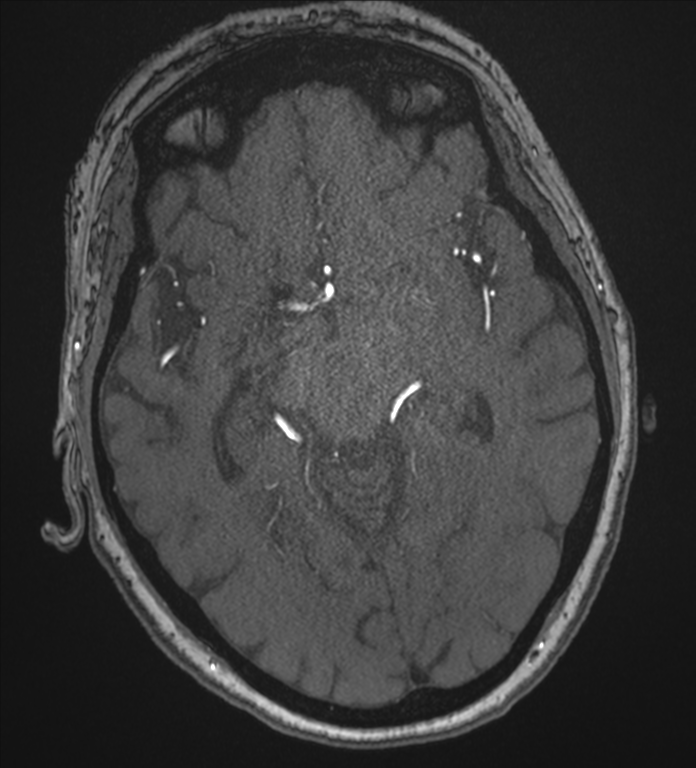 Bilateral fetal posterior communicating arteries (Radiopaedia 41286-44102 Axial MRA 93).png