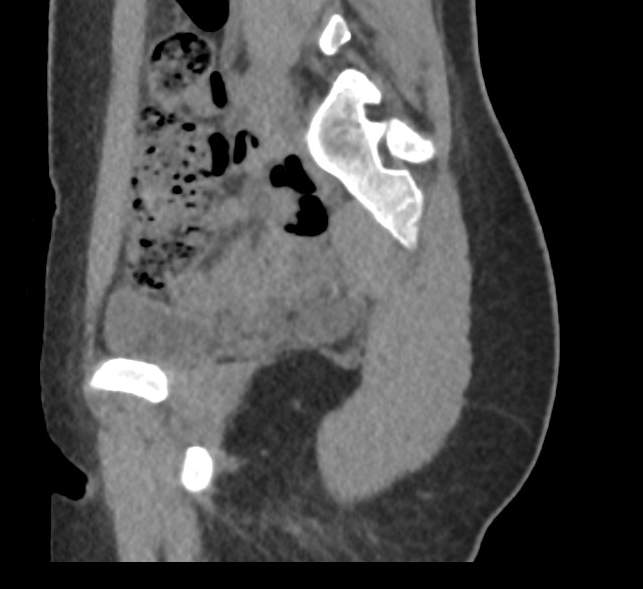 File:Bilateral mature cystic ovarian teratoma (Radiopaedia 88821-105592 D 14).jpg