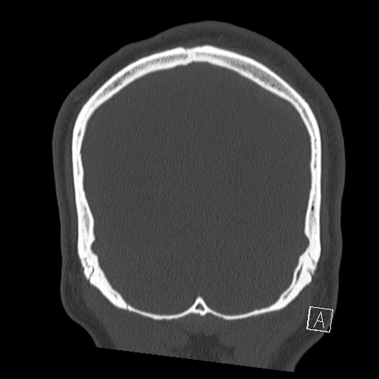 Bilateral occipital condyle fracture (type 2) (Radiopaedia 87675-104089 Coronal bone window 124).jpg