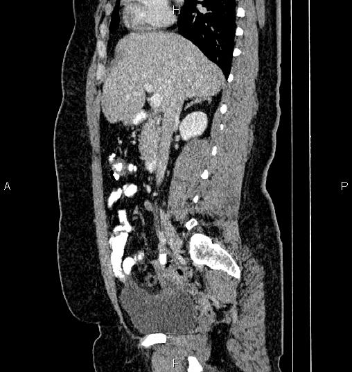 Bilateral ovarian dermoid cysts (Radiopaedia 85785-101603 D 35).jpg
