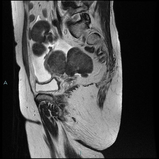 File:Bilateral ovarian fibroma (Radiopaedia 44568-48293 Sagittal T2 23).jpg