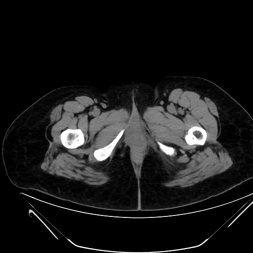 File:Bilateral ovarian mature cystic teratomas (Radiopaedia 79373-92457 Axial non-contrast 105).jpg