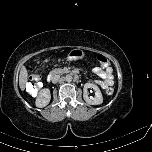File:Bilateral ovarian serous cystadenocarcinoma (Radiopaedia 86062-101989 Axial C+ delayed 25).jpg