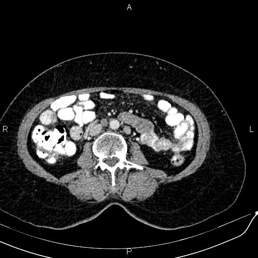 Bilateral ovarian serous cystadenocarcinoma (Radiopaedia 86062-101989 B 54).jpg