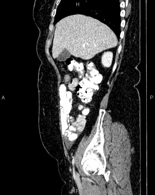 Bilateral ovarian serous cystadenocarcinoma (Radiopaedia 86062-101989 E 16).jpg