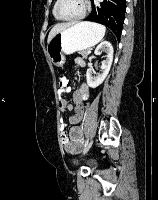 Bilateral ovarian serous cystadenocarcinoma (Radiopaedia 86062-101989 E 58).jpg