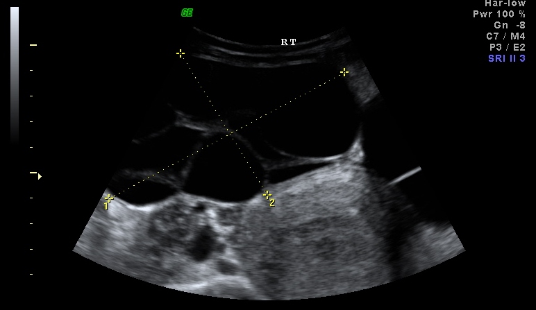 File:Bilateral ovarian serous cystadenoma (Radiopaedia 16979-16686 Transverse 1).JPG