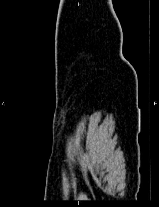 Bilateral ovarian teratoma (Radiopaedia 83131-97503 D 111).jpg