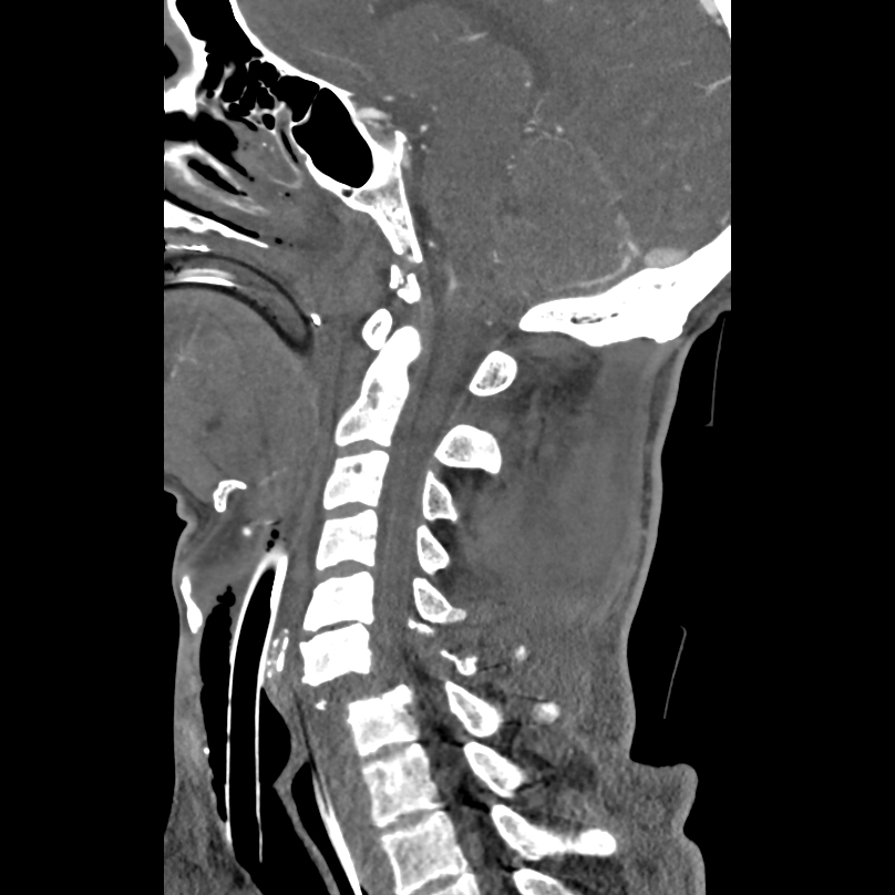 Bilateral perched facets with cord injury (Radiopaedia 45587-49713 B 26).jpg