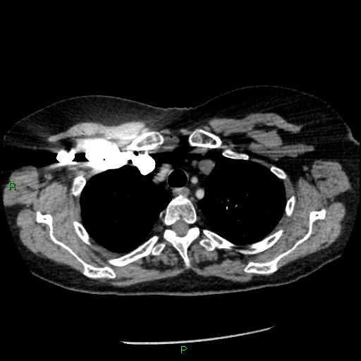 File:Bilateral pulmonary emboli (Radiopaedia 32700-33669 Axial C+ CTPA 17).jpg