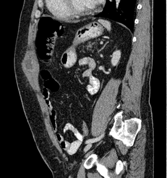 Bilateral rectus sheath hematomas (Radiopaedia 50778-56252 B 53).jpg