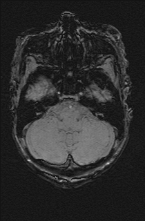 File:Bilateral subdural hemorrhage and parietal skull fracture (Radiopaedia 26058-26190 Axial SWI 13).png