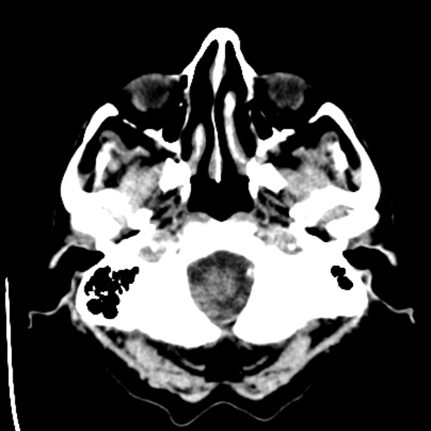 Bilateral subdural hygromata (Radiopaedia 29245-29656 Axial non-contrast 4).jpg