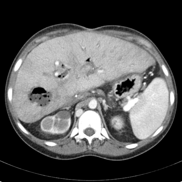 Biliary necrosis - liver transplant (Radiopaedia 21876-21846 B 21).jpg
