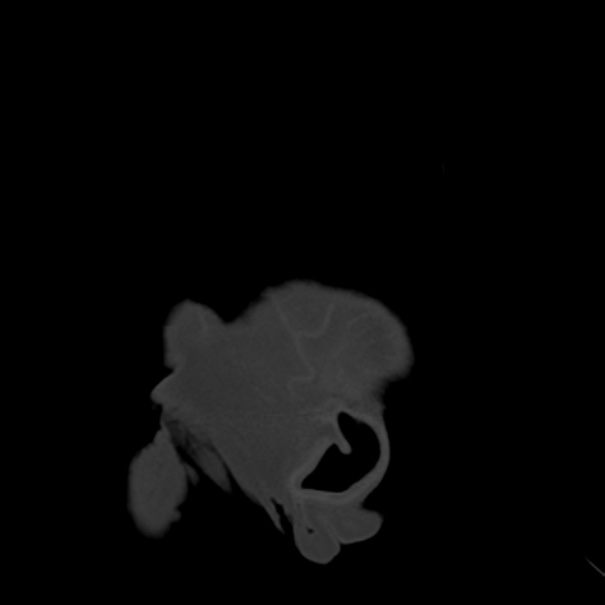 Biparietal osteodystrophy (Radiopaedia 46109-50463 Sagittal bone window 103).jpg
