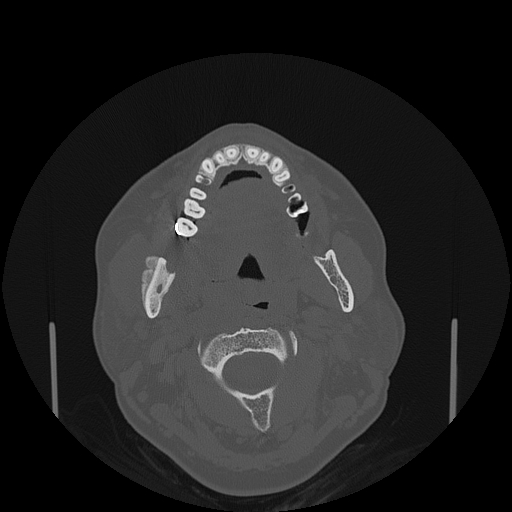 File:Bisphosphonate-related osteonecrosis of the jaw (Radiopaedia 71324-81642 Axial bone window 90).jpg