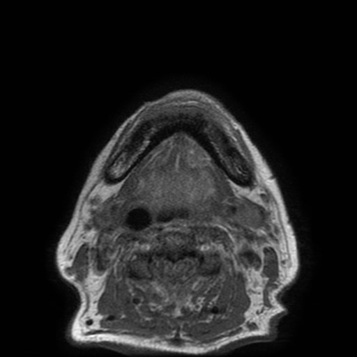 Bisphosphonate-related osteonecrosis of the maxilla (Radiopaedia 51367-57101 Axial T1 5).jpg