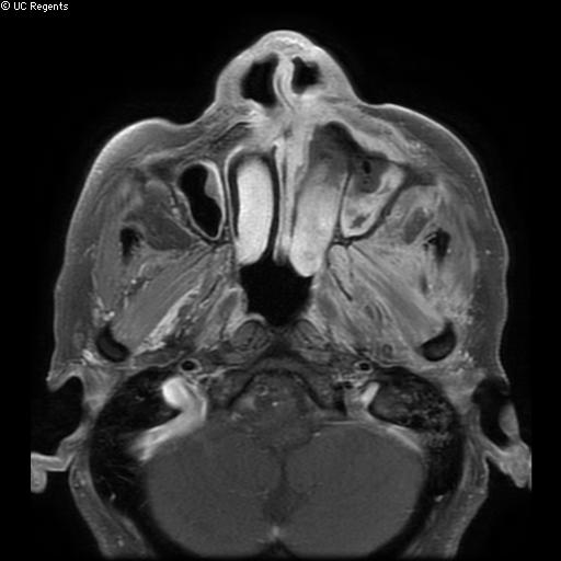 Bisphosphonate-related osteonecrosis of the maxilla (Radiopaedia 51367-57101 Axial T1 C+ fat sat 24).jpg