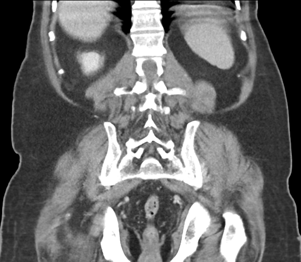 Bladder papillary urothelial carcinoma (Radiopaedia 48119-52951 C 50).png