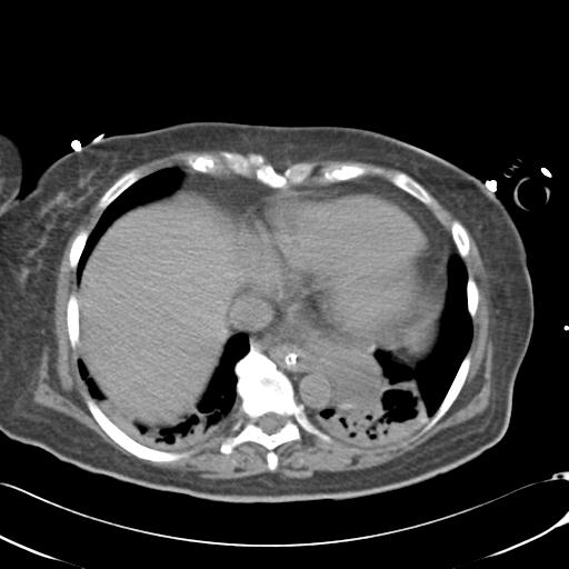 Bladder rupture post renal biopsy (Radiopaedia 30863-31572 Axial non-contrast 9).jpg