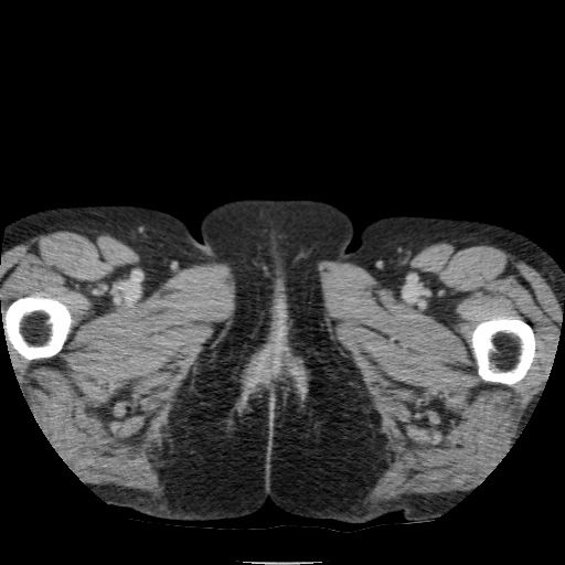 Bladder tumor detected on trauma CT (Radiopaedia 51809-57609 C 155).jpg