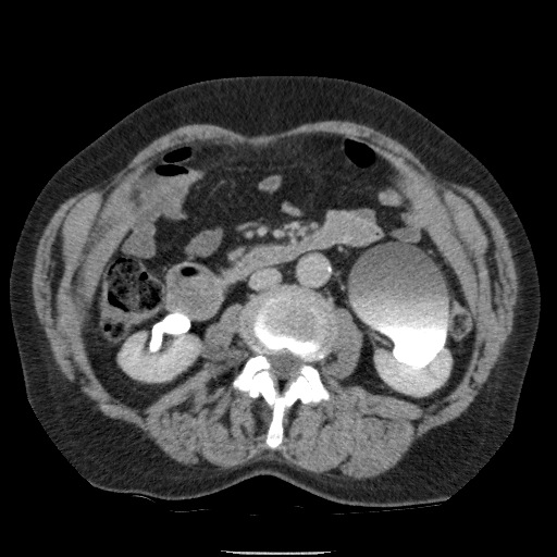 Bladder tumor detected on trauma CT (Radiopaedia 51809-57609 C 65).jpg