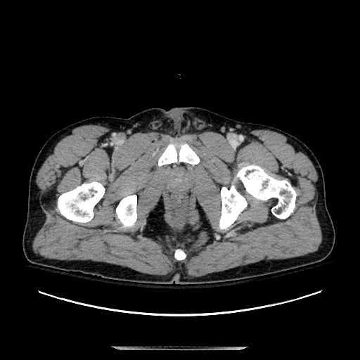 Blunt abdominal trauma with solid organ and musculoskelatal injury with active extravasation (Radiopaedia 68364-77895 A 158).jpg